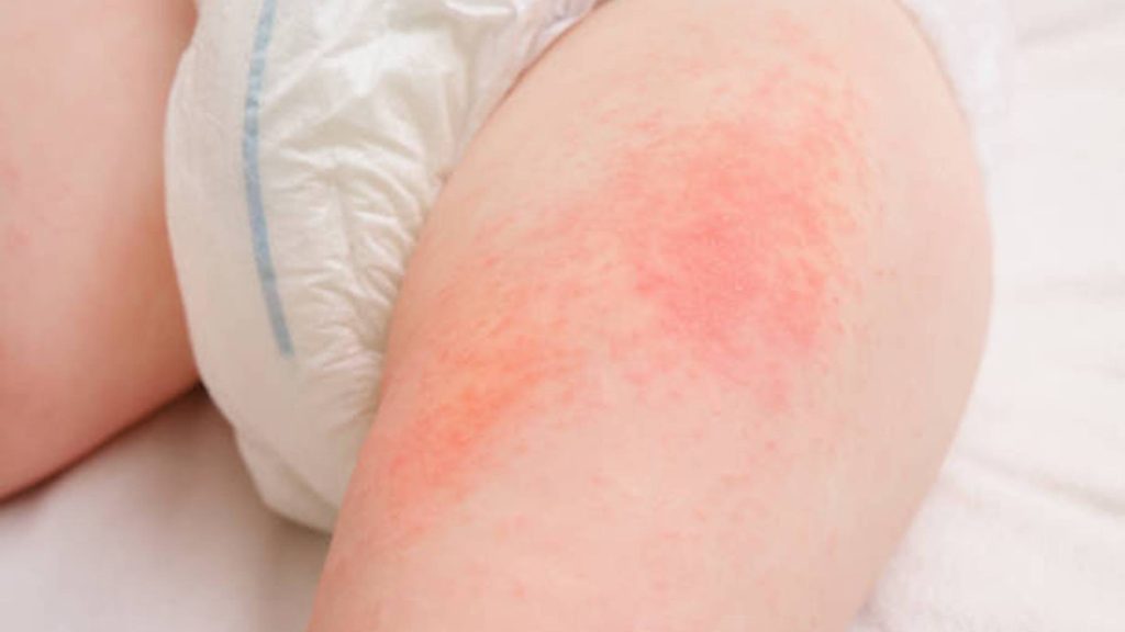 10 Natural Ways to Relieve Diaper Rash in Summer