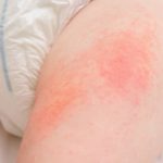 10 Natural Ways to Relieve Diaper Rash in Summer